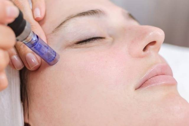 Tratamiento Dermapen