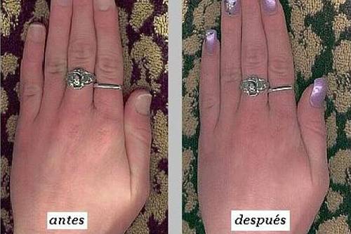 Transformación de las uñas