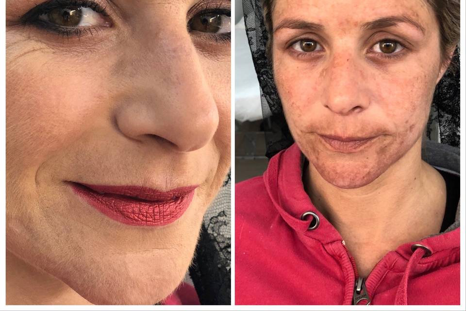 Antes y después con acné