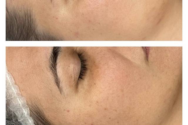 Tratamiento neosus
