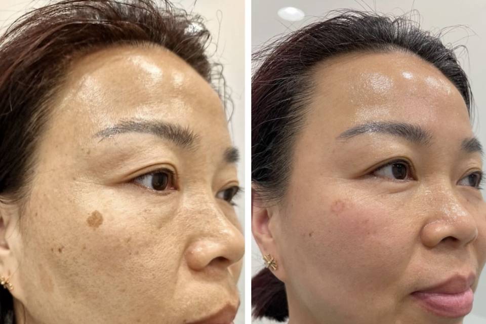 Tratamiento de peeling químico