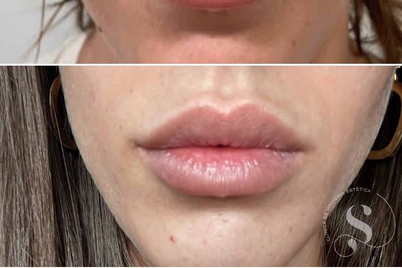 Tratamiento de labios