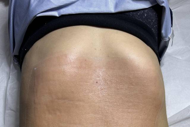 Abdomen plano