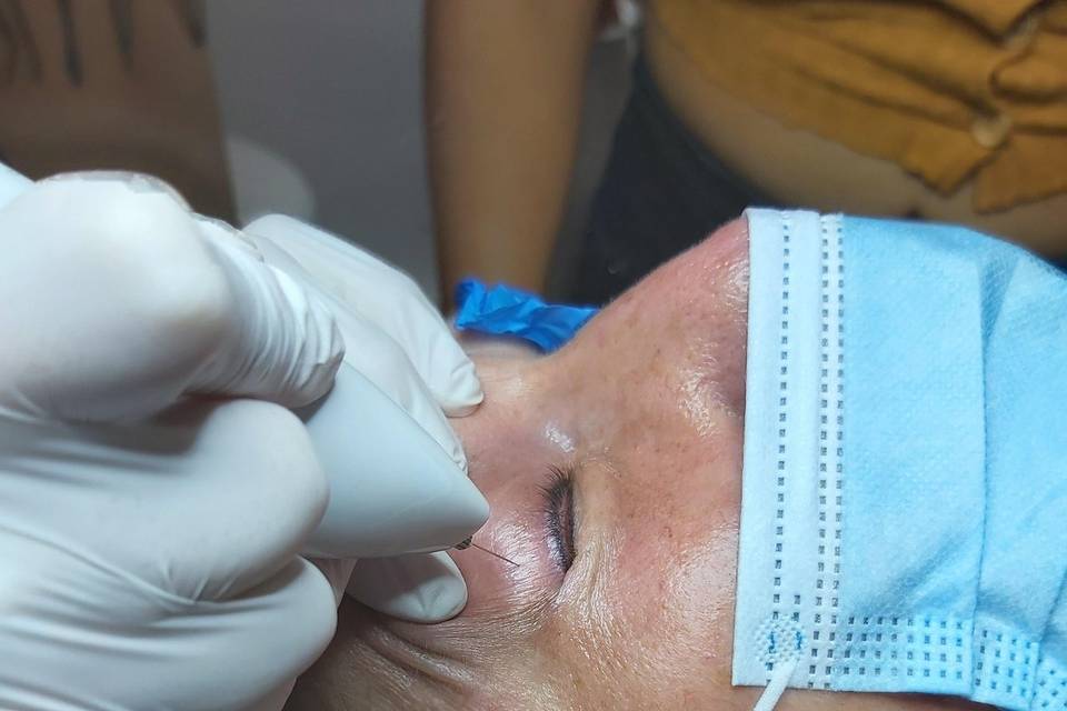 Blefaroplastia sin cirugia