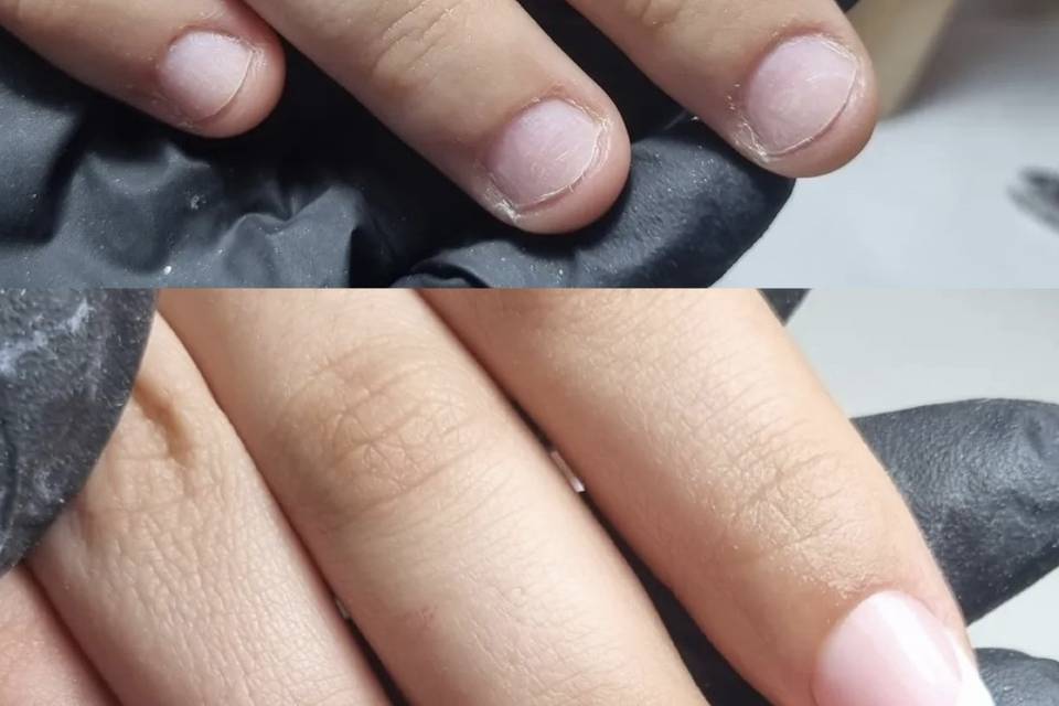Uñas mordidas