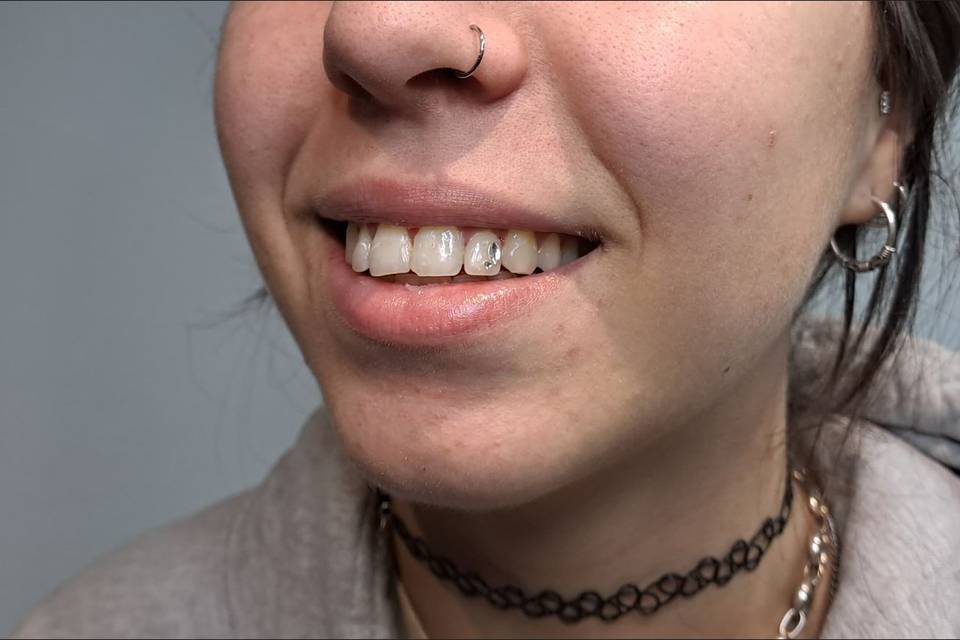 Composicion con gemas dentales