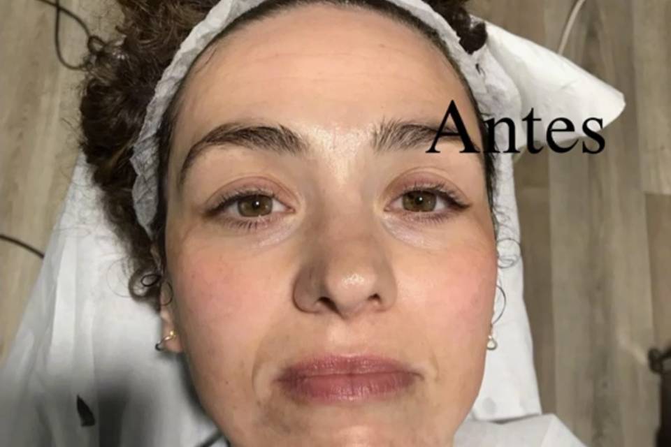 Limpieza facial Carbón Activo