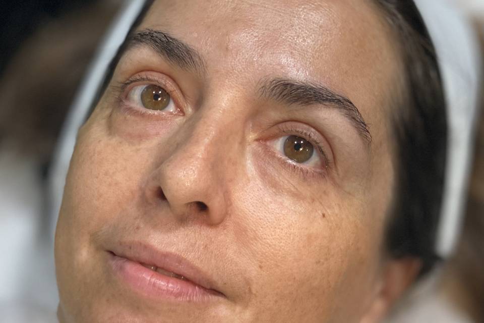 Tratamiento Pico LASER