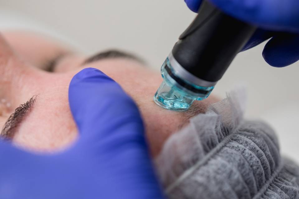 Limpieza hydrafacial