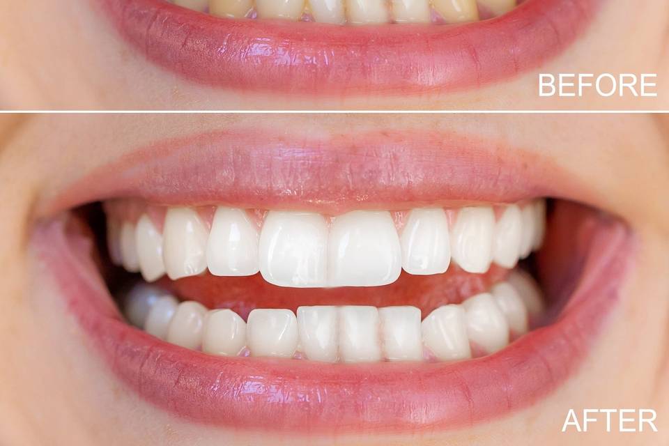 Antes y Dèspues de Ella