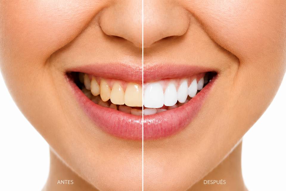 Smilyn - Blanqueamiento Dental
