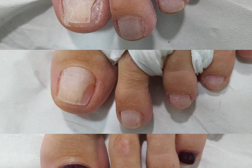 Reconstrucción uñas del pie